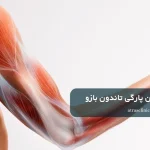 روش های درمان پارگی تاندون بازو
