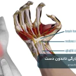 راه‌های درمان پارگی تاندون دست