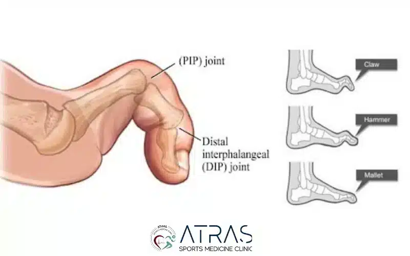 انواع انگشت چنگالی پا