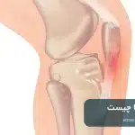 تاندون پاتلا