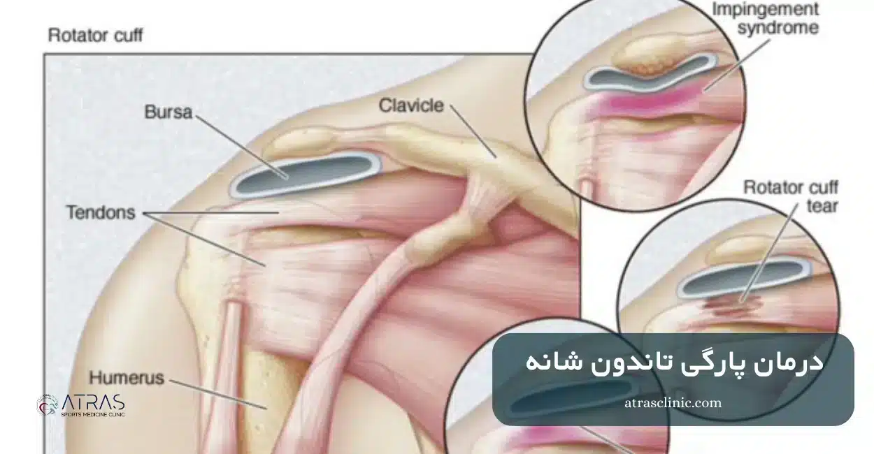 درمان پارگی تاندون شانه بدون جراحی