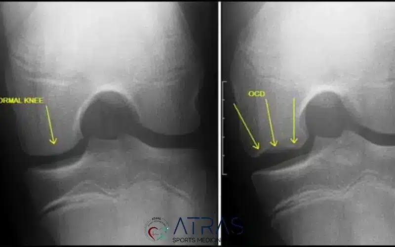 محل ایجاد استئوکندریت دیسکان