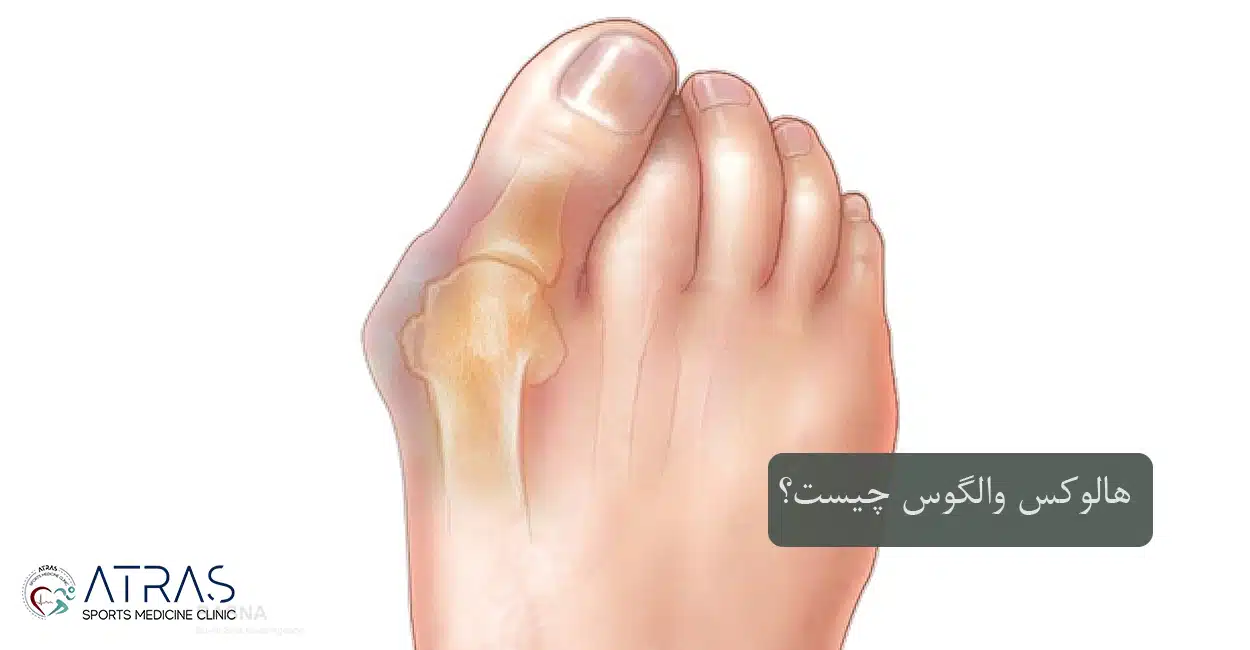 هالوکس والگوس چیست؟