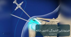 فیزیوتراپی کشیدگی تاندون شانه