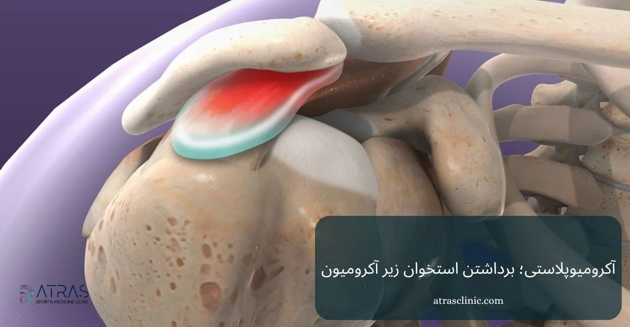 آکرومیوپلاستی