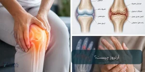 آرتروز چیست؟ بررسی علائم، علتها، انواع و روشهای درمان آرتروز
