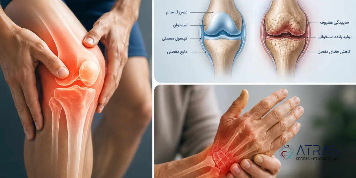 آرتروز چیست؟ بررسی علائم، علتها، انواع و روشهای درمان آرتروز