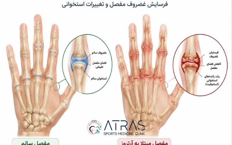 آرتروز دست